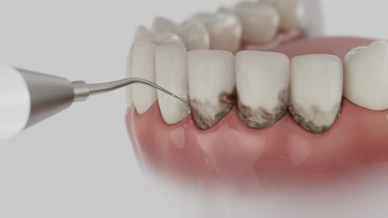 Reliable Wisdom Tooth Removal contractor in Pierce County County, WA by Dentist Open Now
